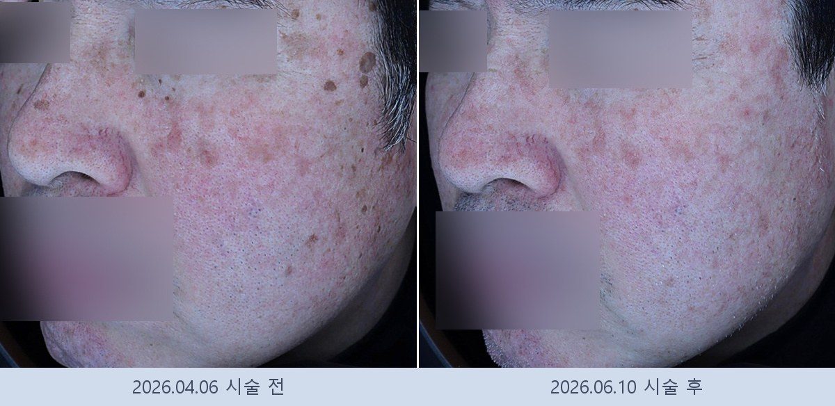 흑자 검버섯