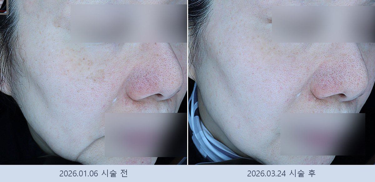 흑자 검버섯