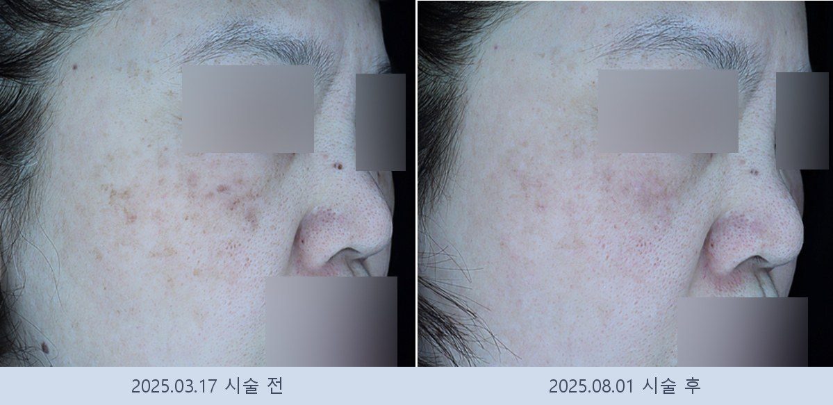 기미 잡티